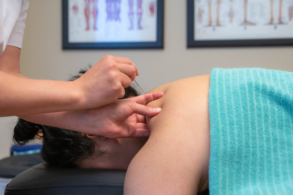 En patient som blir behandlad med dry needling på axeln och ryggen.