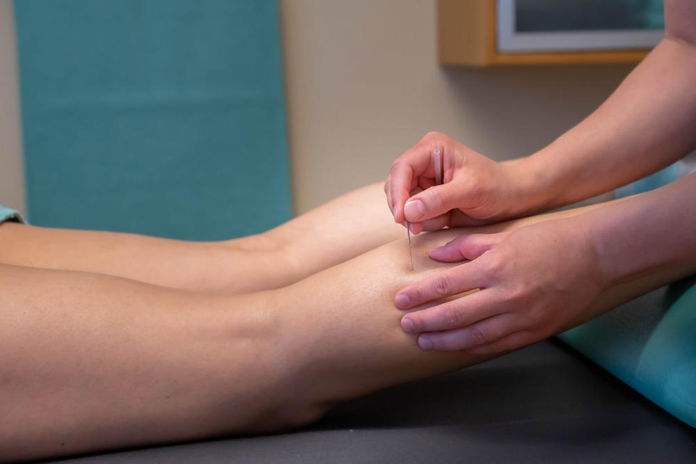 Dry Needling - Närbild på behandling med dry needling på en vad