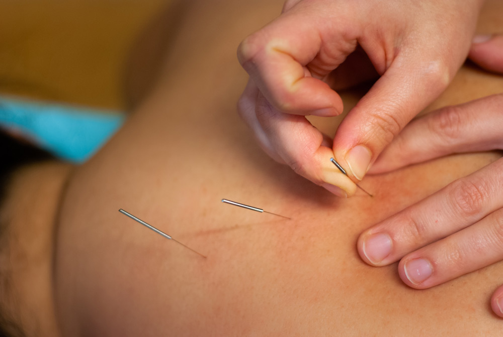 Akupunktur - Närbild på när en behandlare sätter akupunkturnålar på en patients rygg